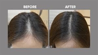 profitable non-surgical hair replacement - 1