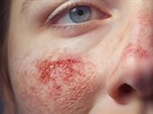 865k sde 50-year allergy