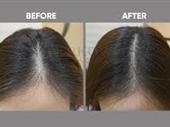 profitable non-surgical hair replacement